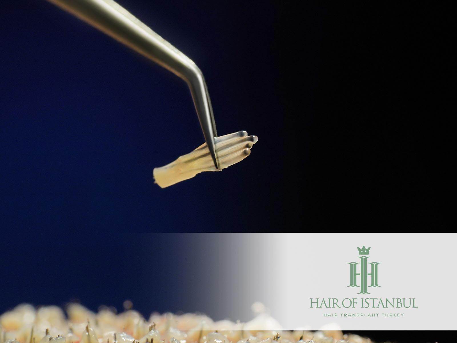 Haarausfall nach Haartransplantation: Was nach 1 Jahr passiert