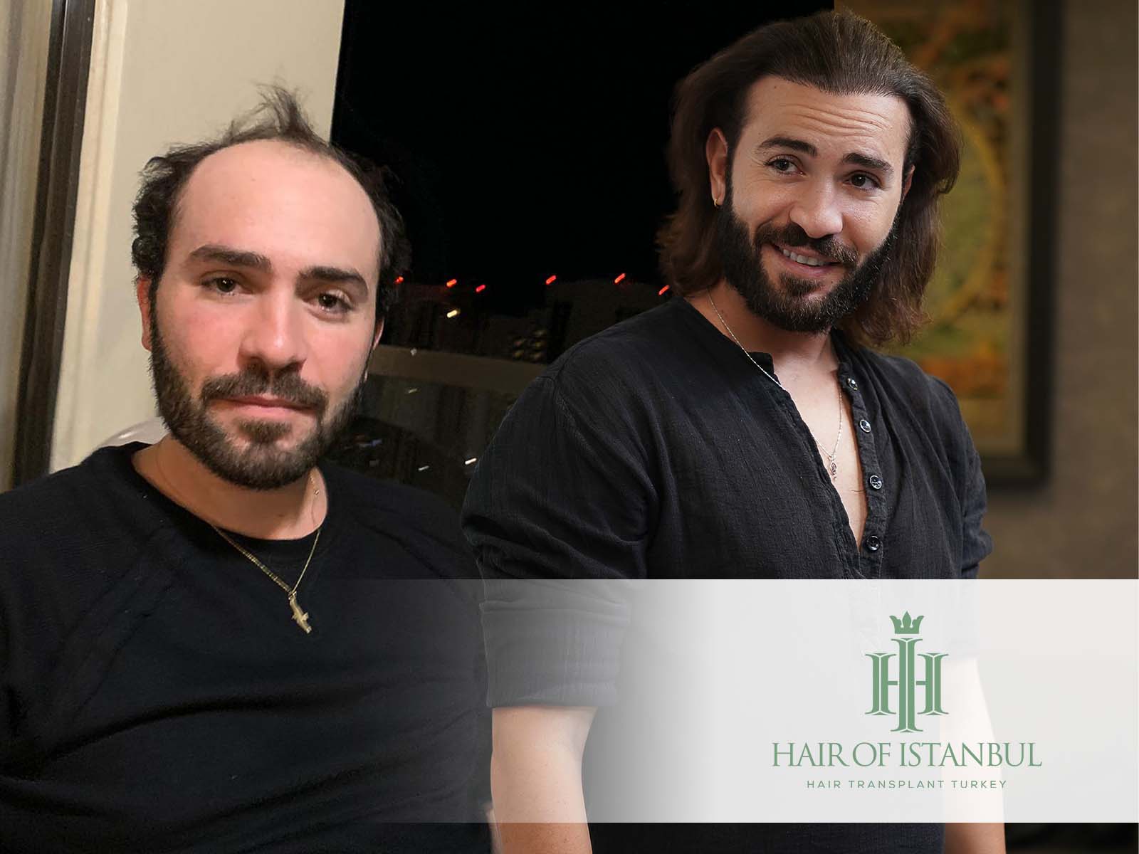 Haarwachstum nach Haartransplantation: 0 – 12 Monat [Zeitleiste]