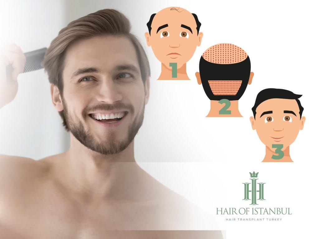 Hair Transplant Recovery Timeline: Day by Day to One Month
