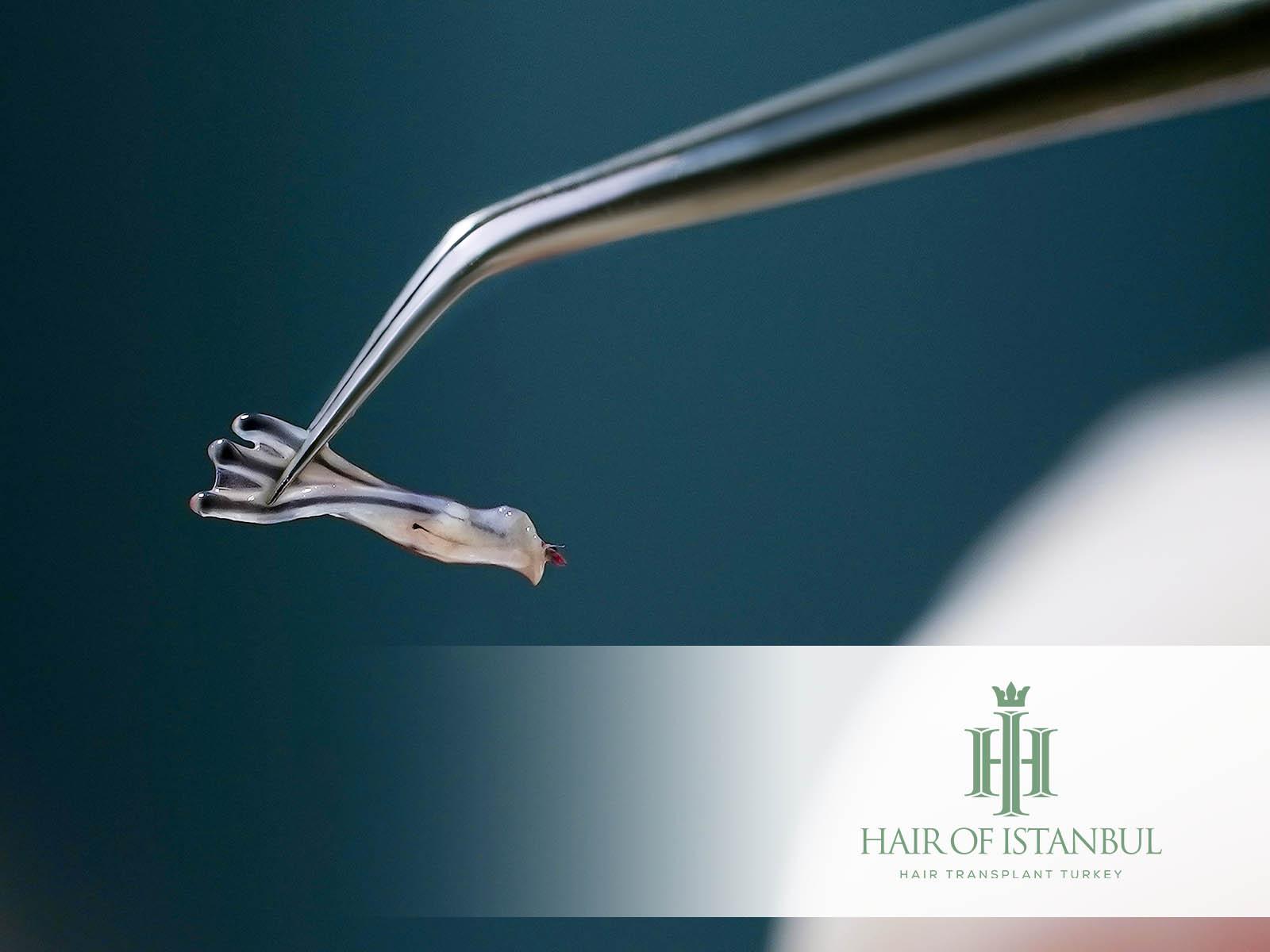 Wann sind die Grafts bei Haartransplantation fest?