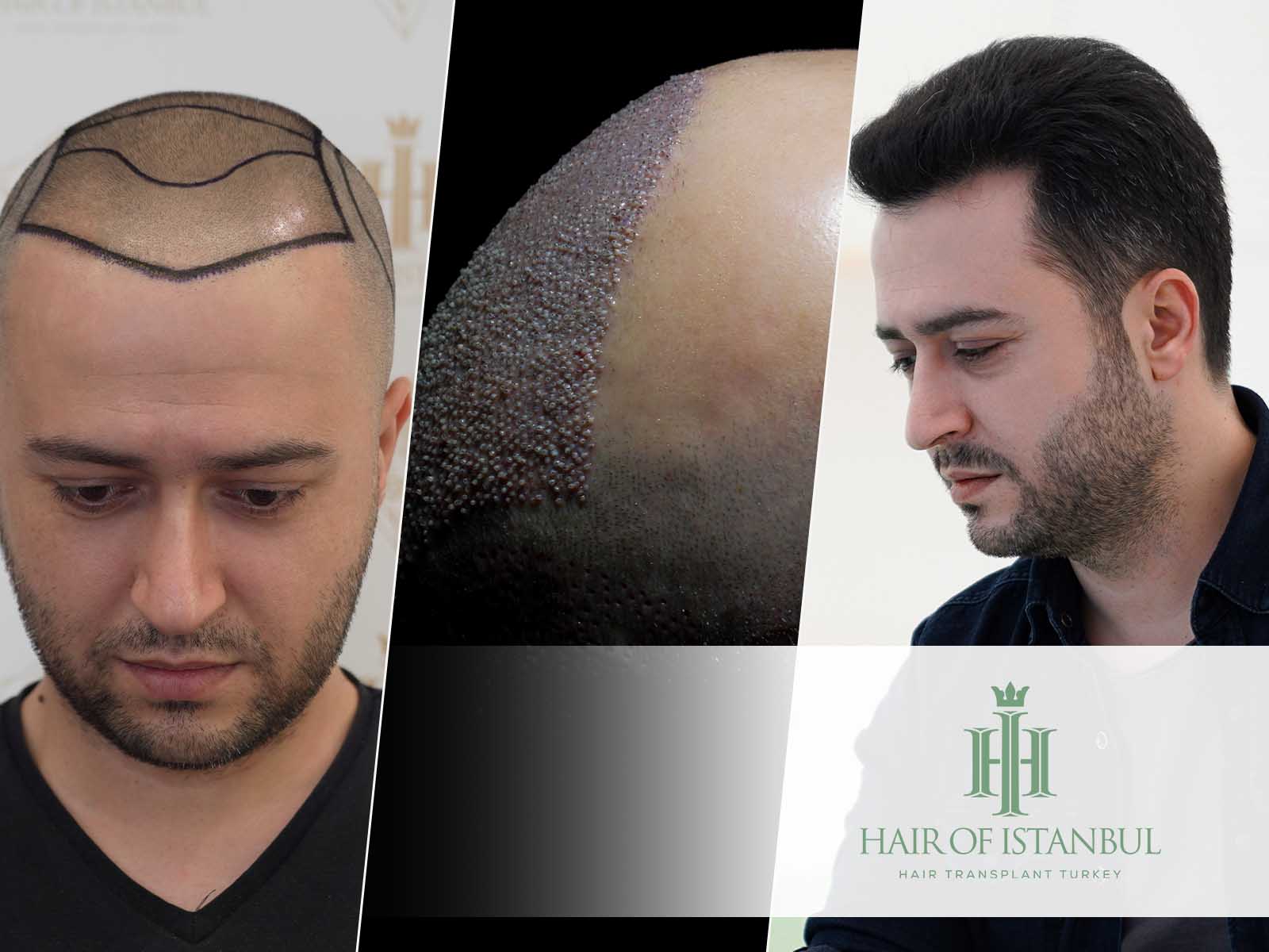 Wie funktioniert eine Haartransplantation? Alle Details hier!
