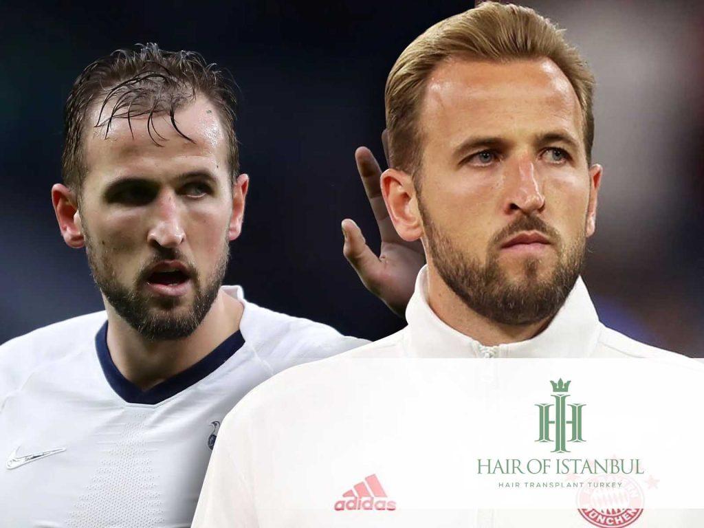 Harry Kane Hair Transplant
