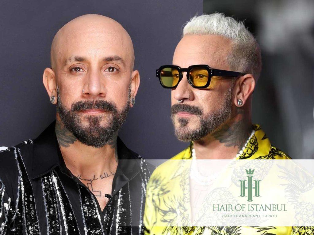 Wie AJ McLean mit einer Haartransplantation sein Aussehen veränderte 2 AJ McLean Hair Transplant