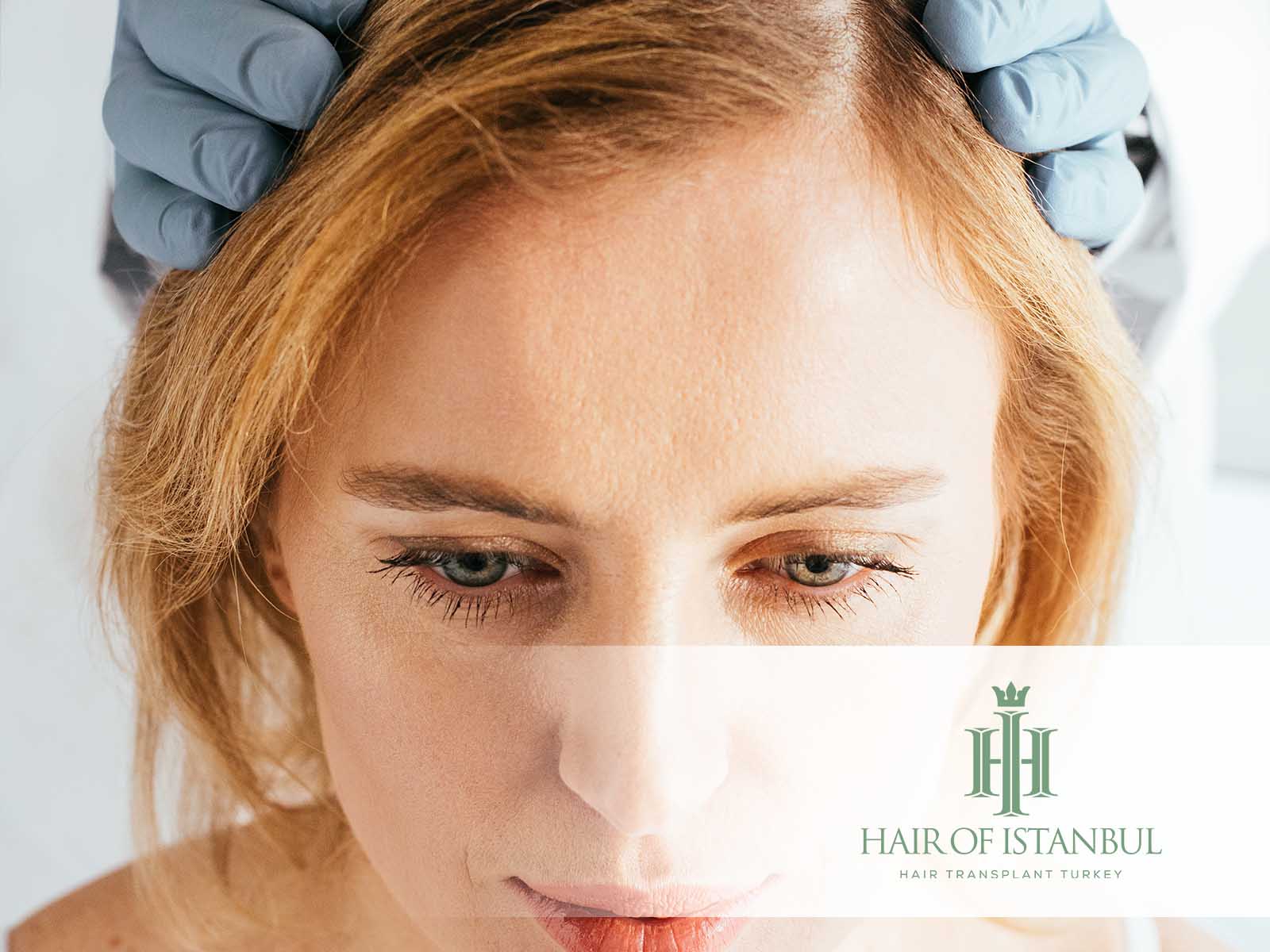 Hohe Stirn bei Frauen: Haartransplantation – Lohnt es sich?
