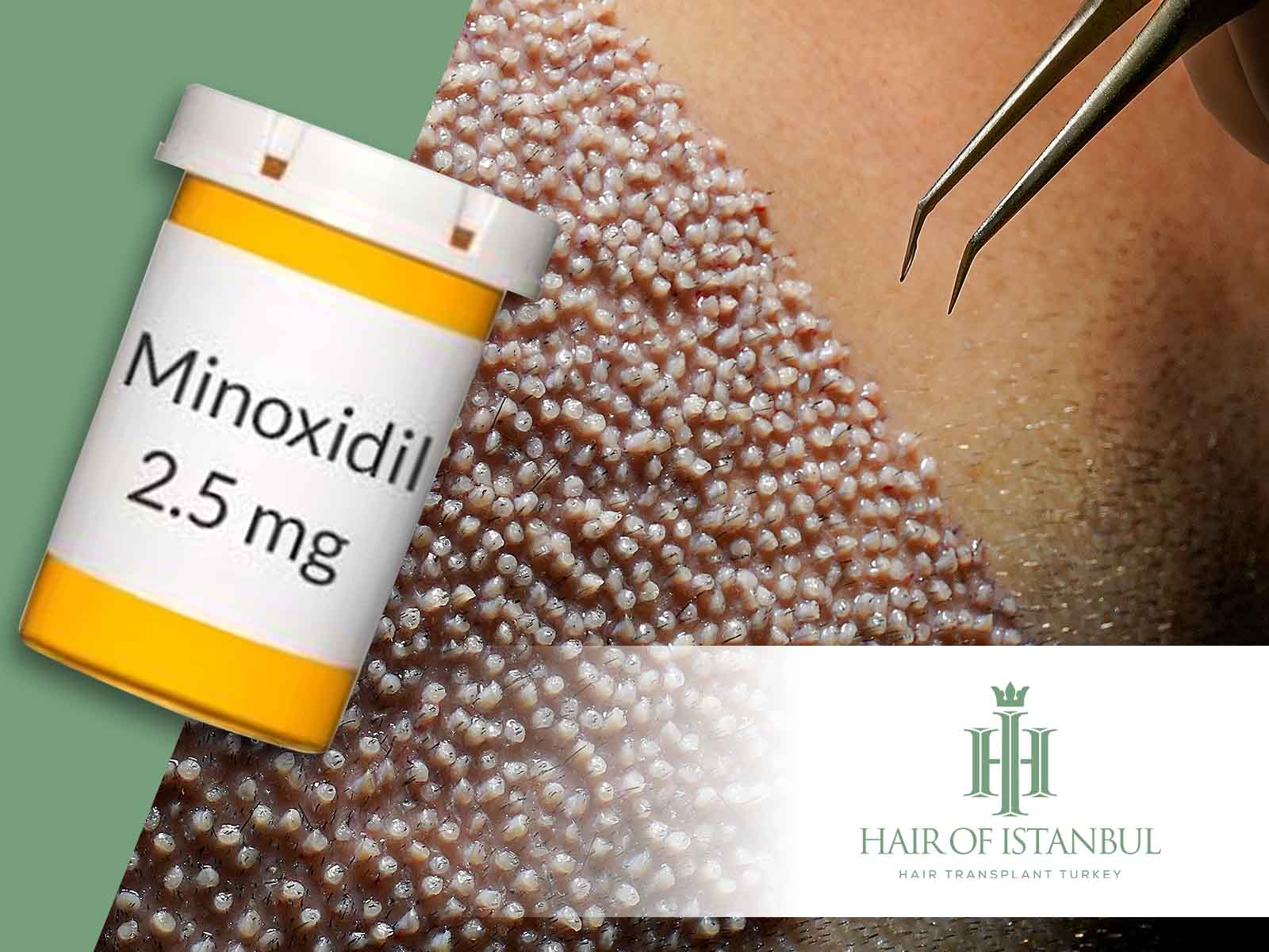 Minoxidil nach Haartransplantation: Muss es verwendet werden?