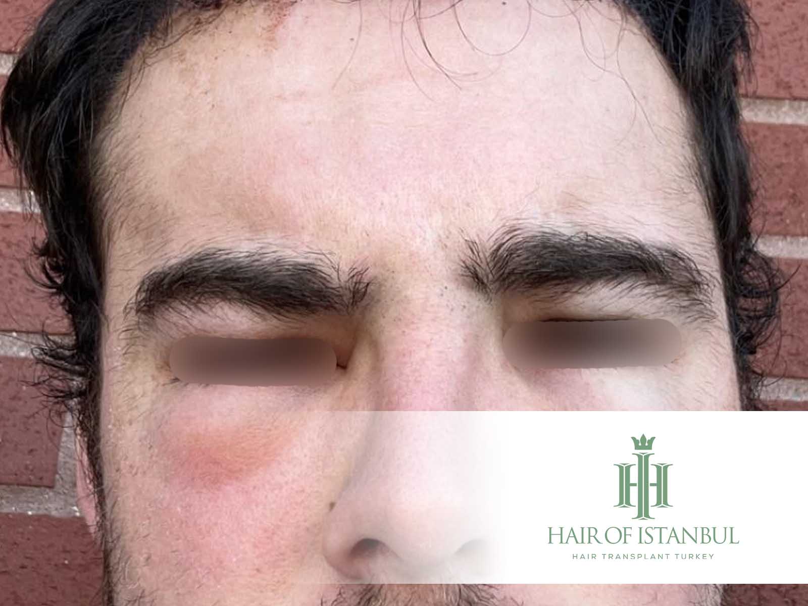 Schwellung nach Haartransplantation: Was ist normal?