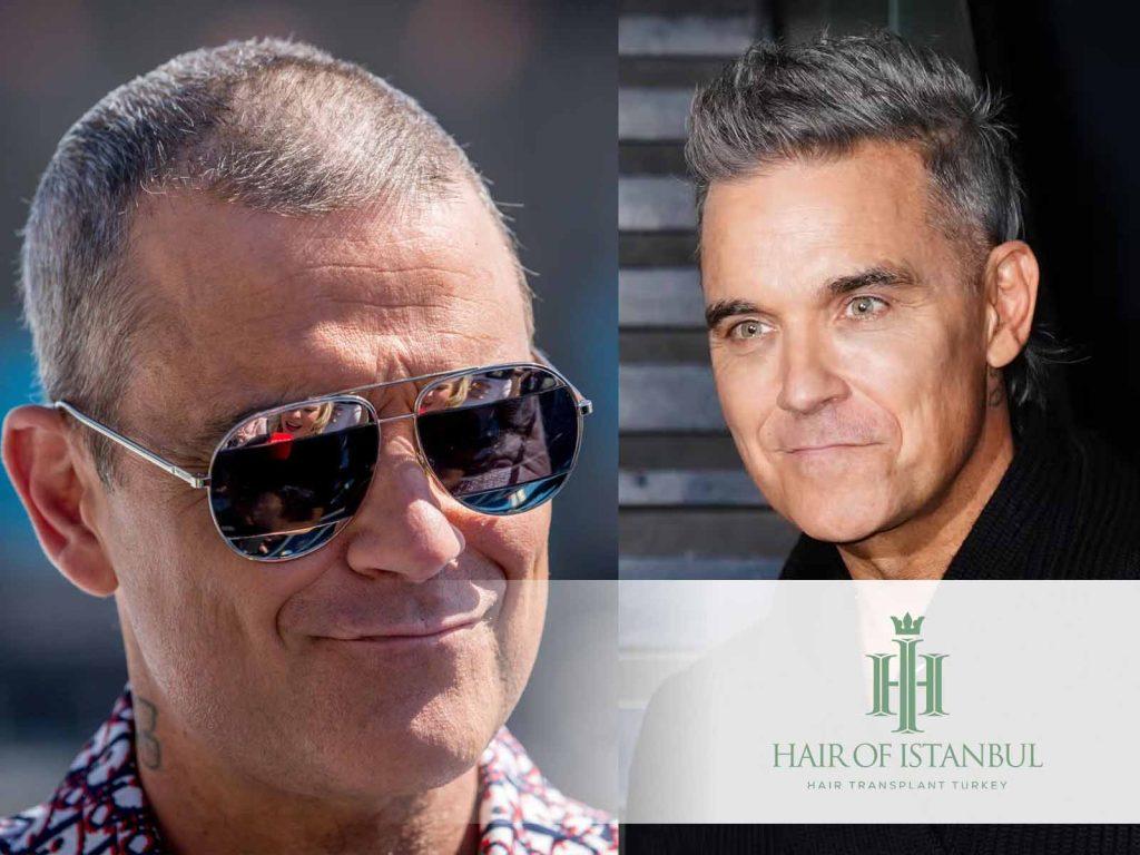 Robbie Williams Hair Transplant