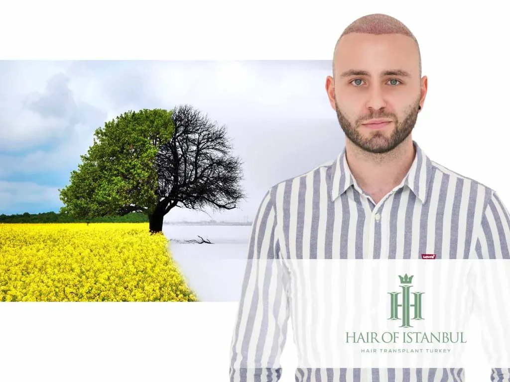Best Season for Hair Transplant: What Actually Changes