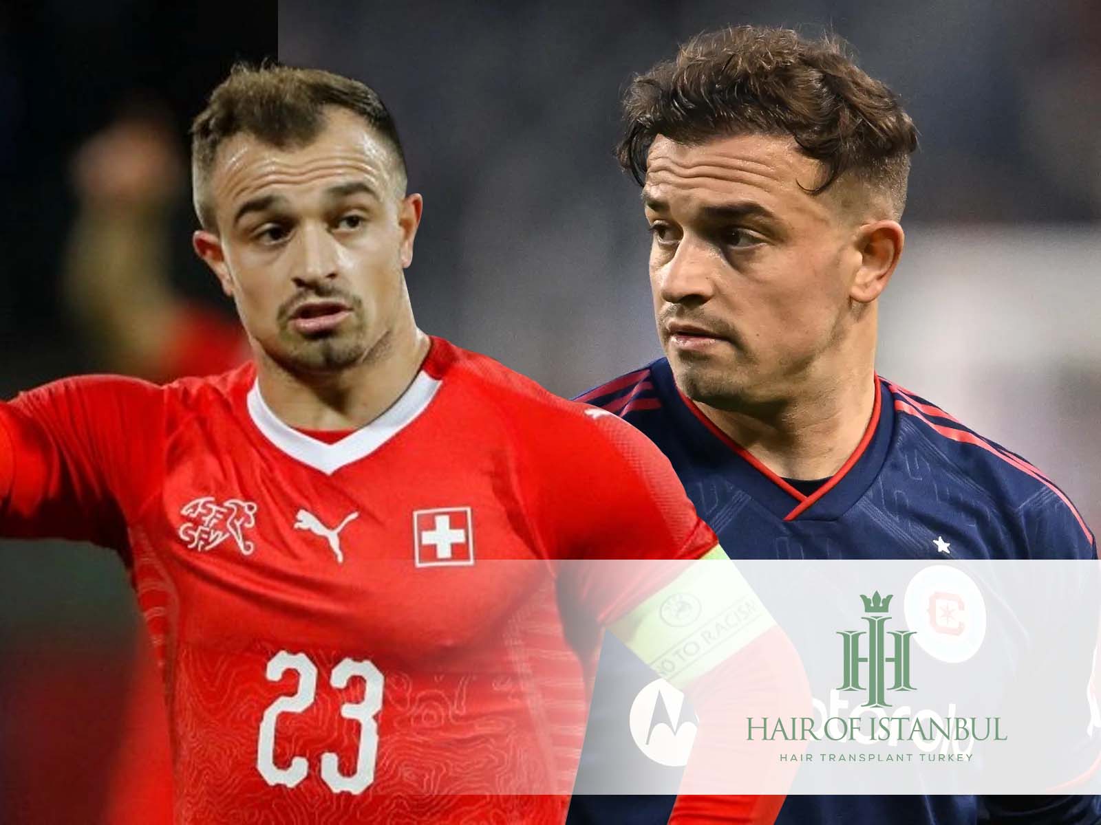 Xherdan Shaqiri Haartransplantation: Wahrheit über seine Haare