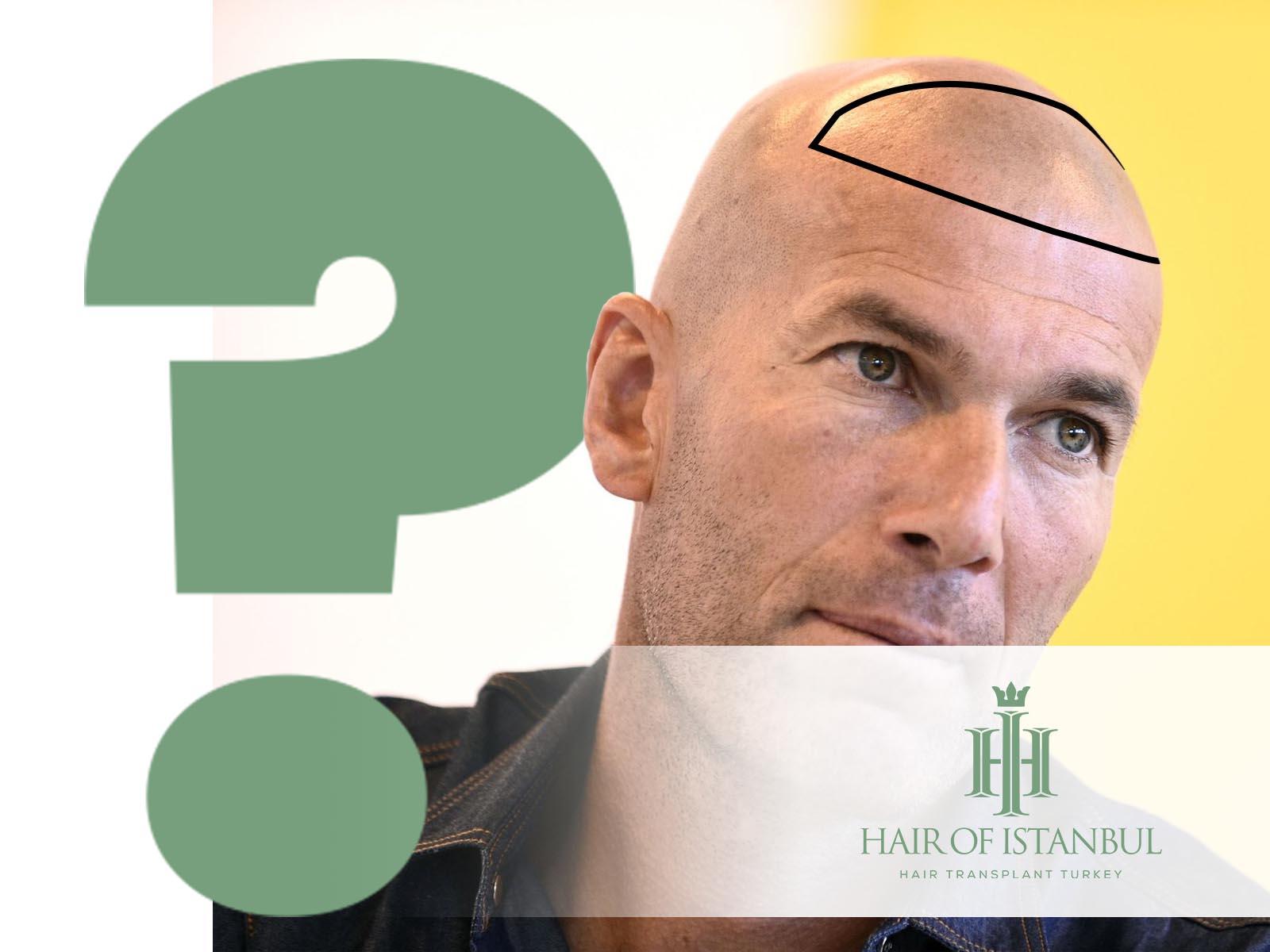 Zidane Haare und die Gerüchte einer Haartransplantation