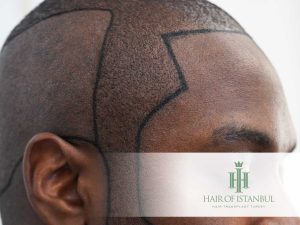 afro type hair transplant