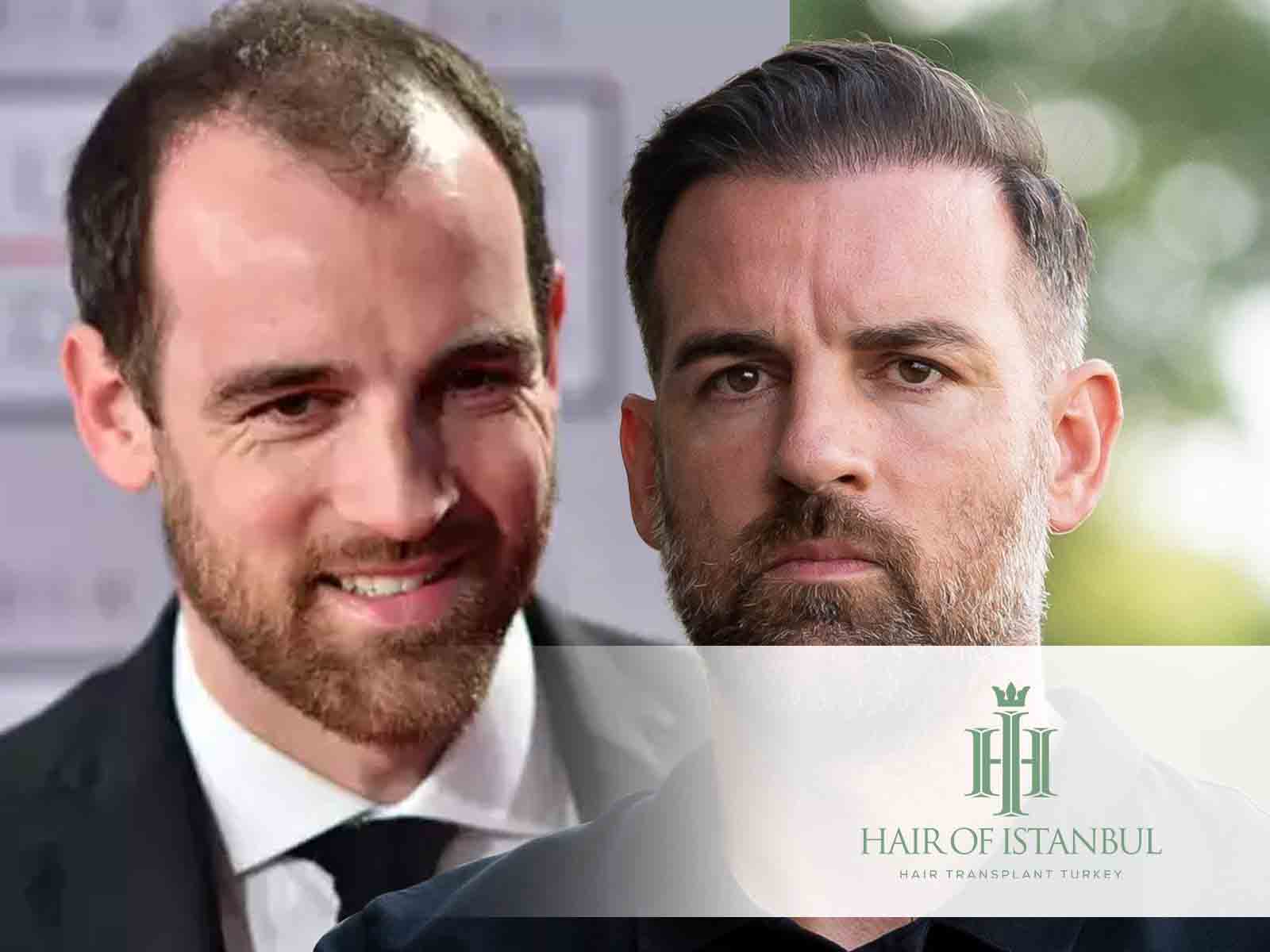 Christoph Metzelder Haartransplantation: Neue Haare Echt?