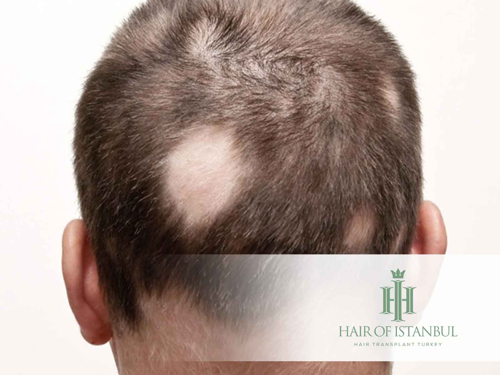 ¿Cómo saber si tengo alopecia? Señales a seguir?