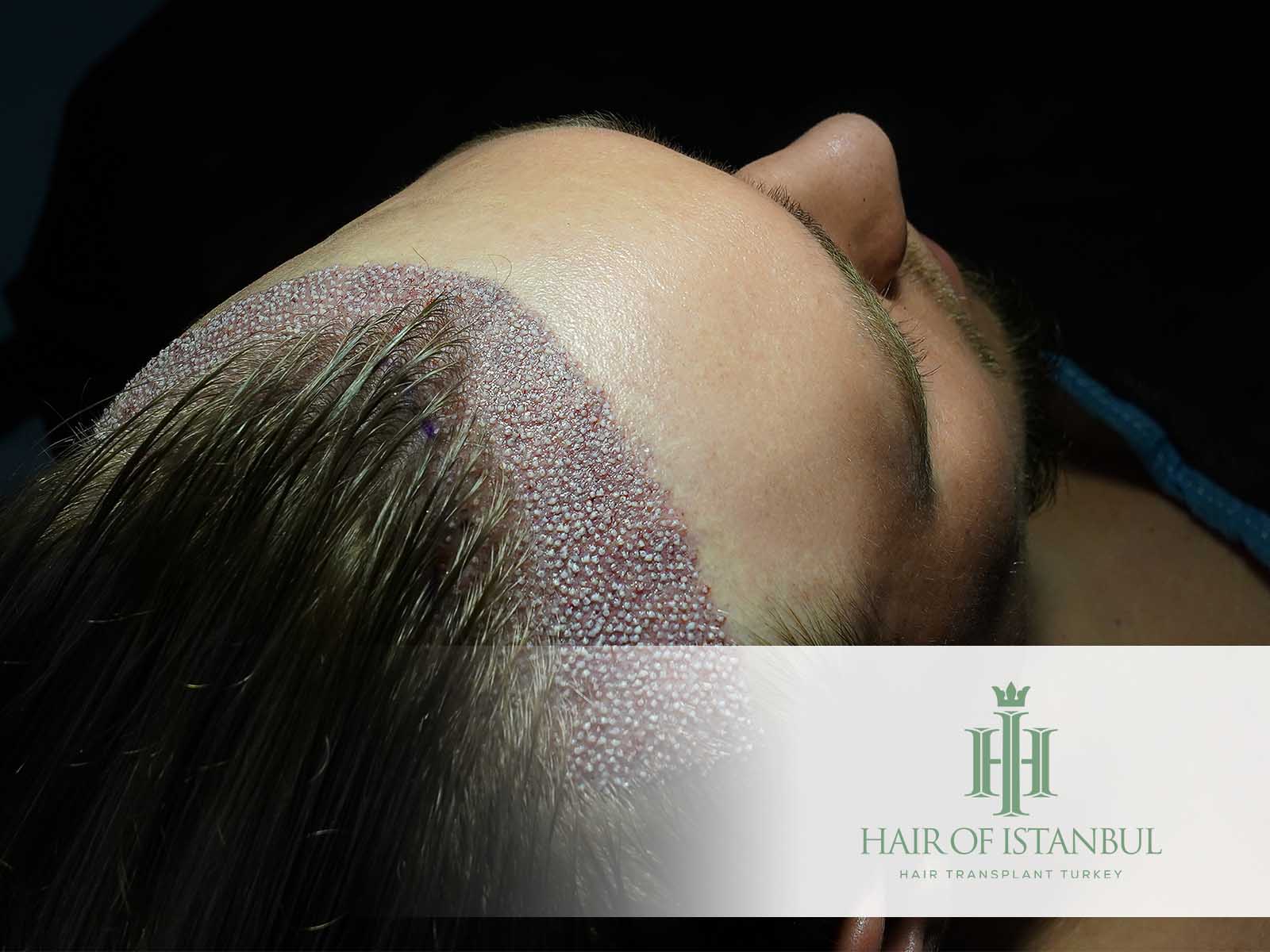 Haartransplantation ohne Rasur: Ein umfassender Leitfaden