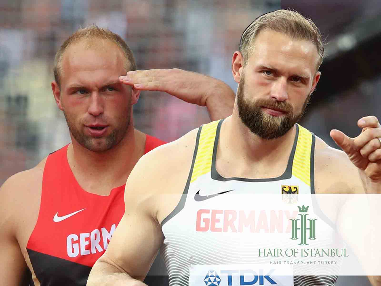 Robert Harting Haartransplantation: Sein Weg zu neuen Haaren