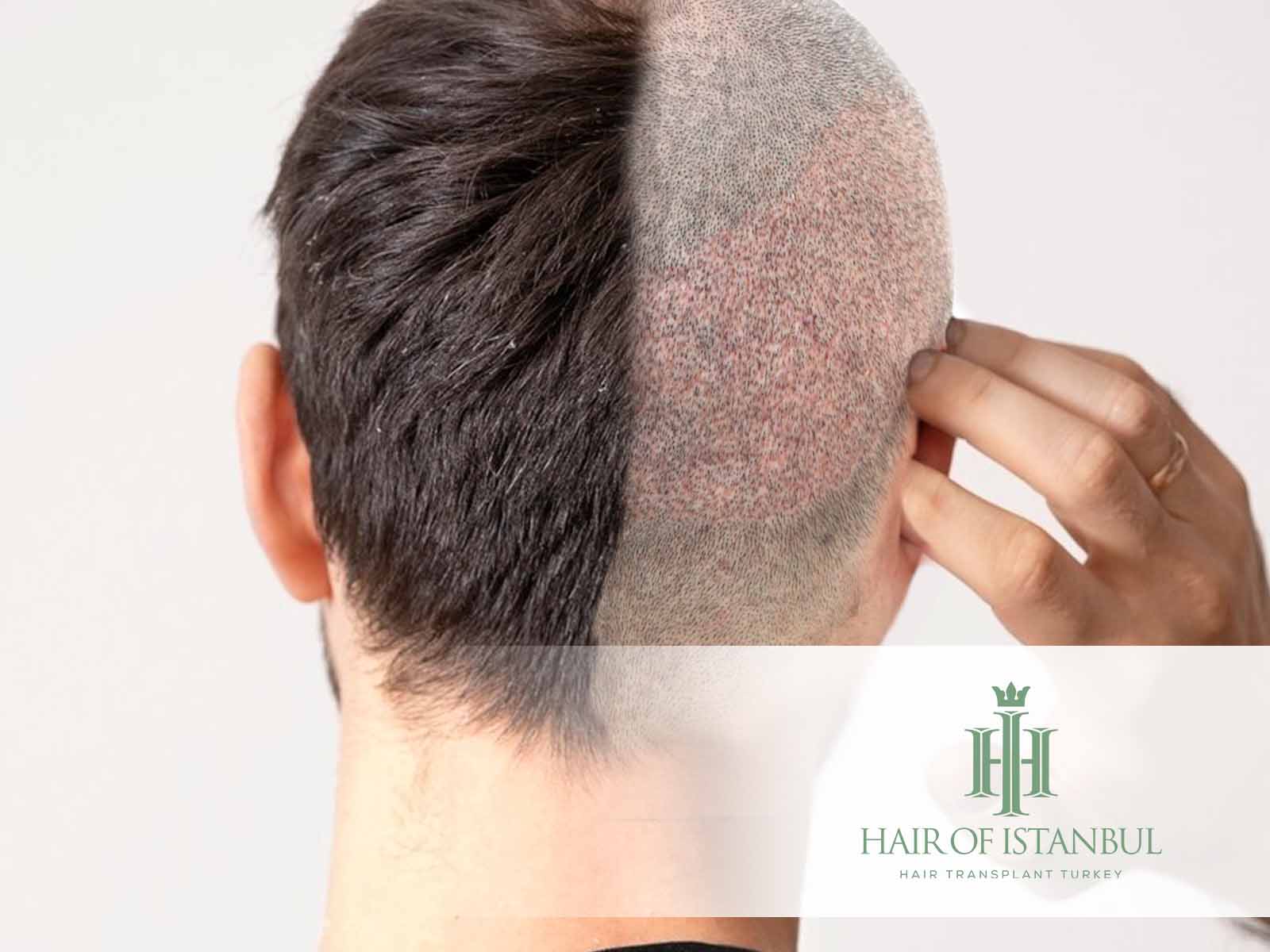Lücken im Spenderbereich nach Haartransplantation