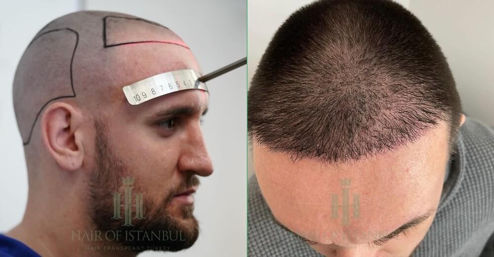 Forehead Reduction Hair Transplant Photos
