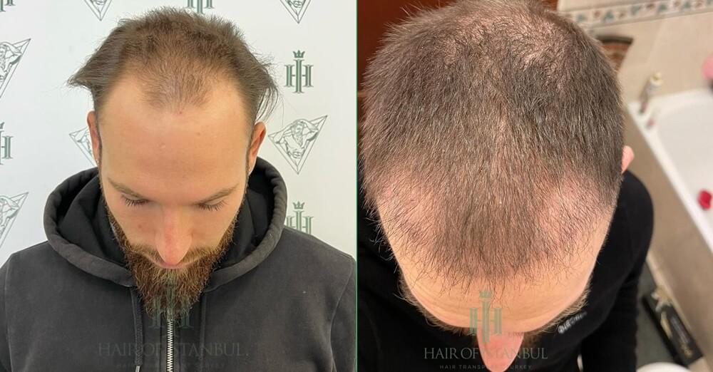Front and Crown Hair Transplant Photos