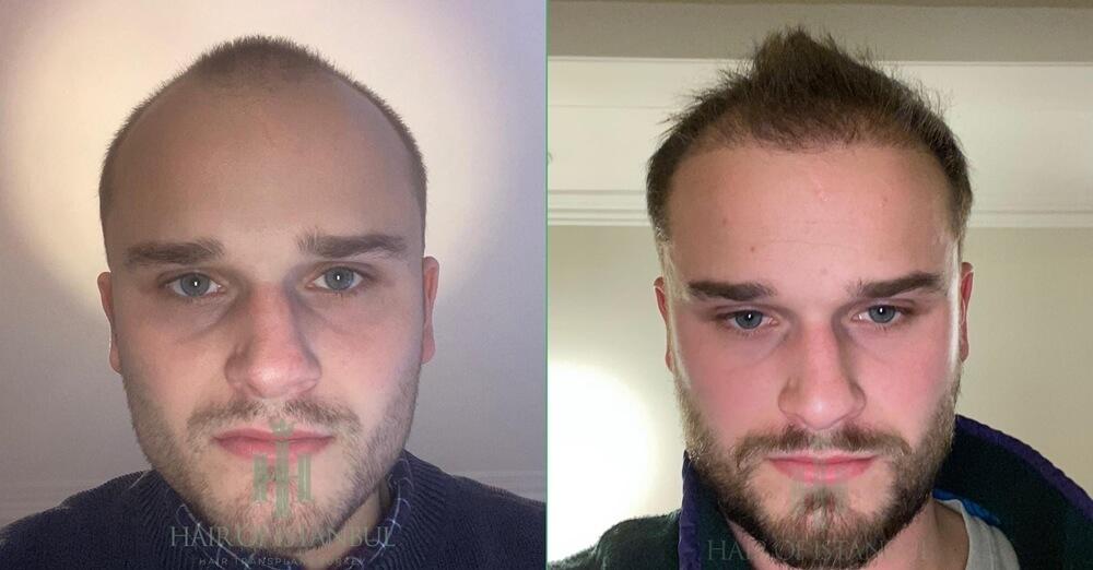 Hair Transplant After 3 Months Photos Show Real Results