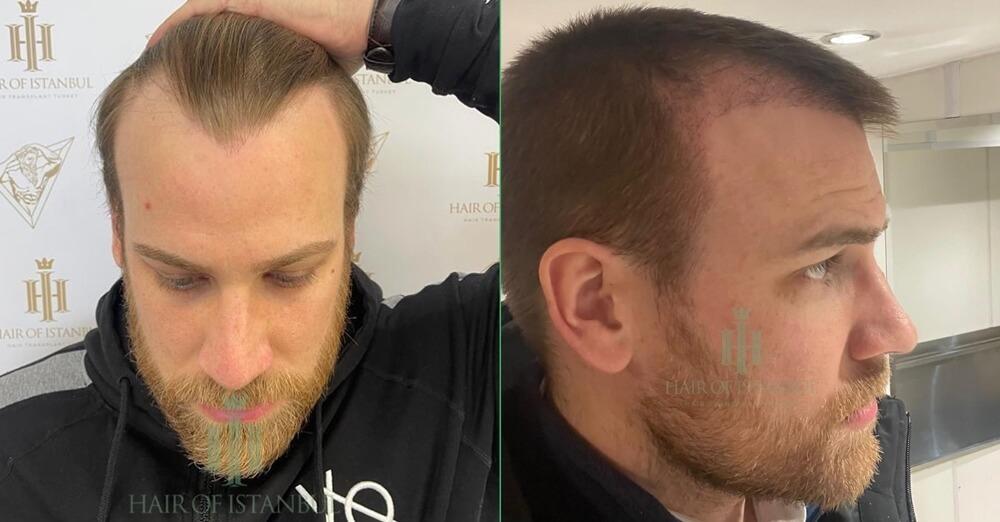 Temple Hair Transplant Photos