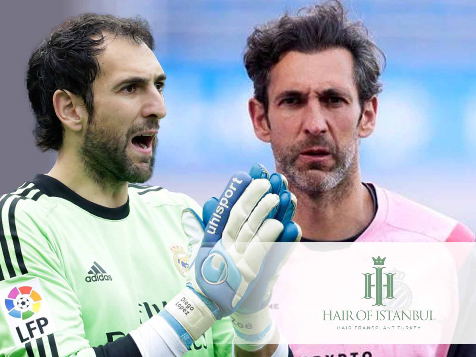El injerto capilar de Diego López: Antes y después del pelo