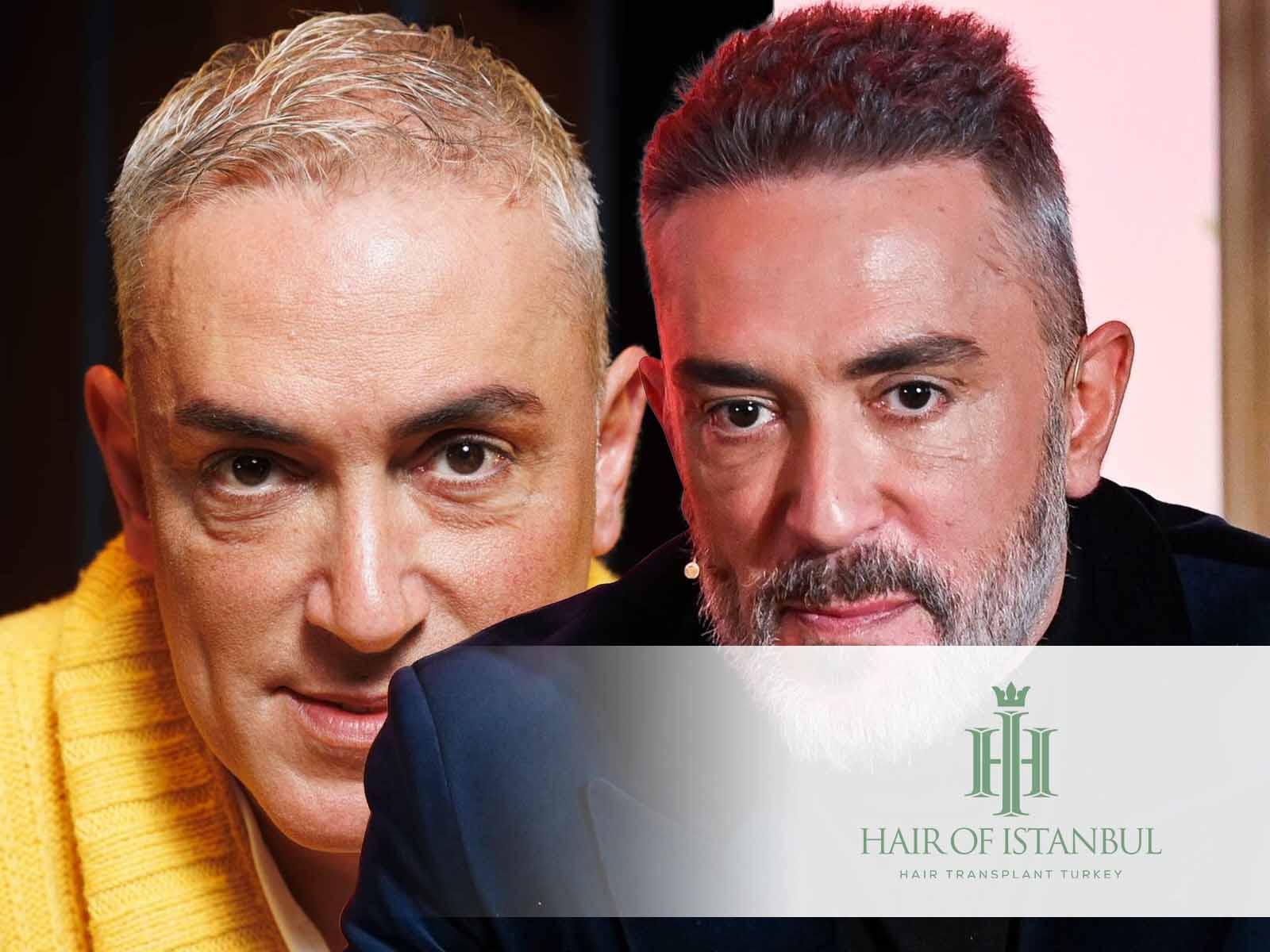 El injerto capilar de Kiko Hernández: Antes y después del pelo