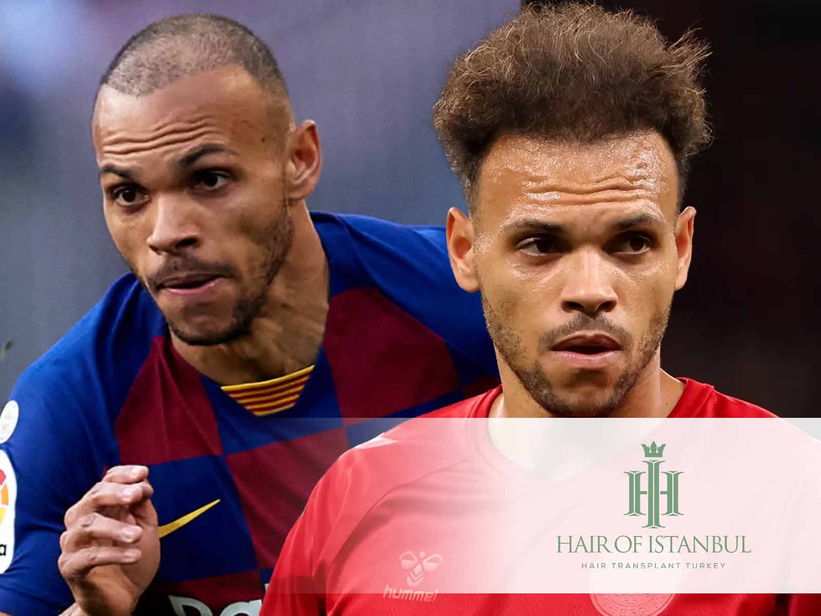 El injerto de pelo de Martin Braithwaite: Todo lo que sabemos