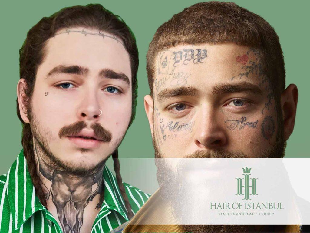 Post Malone Hair Transplant: Did He Really Get One?