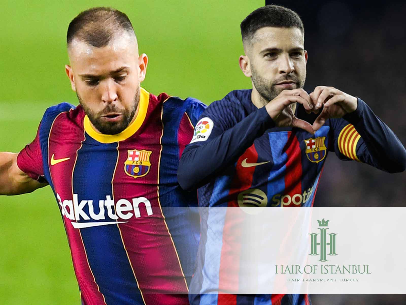 El injerto capilar de Jordi Alba: Antes y después del pelo