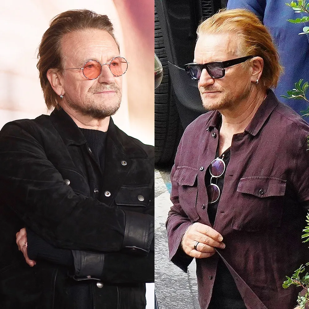 bono-hair-transplant