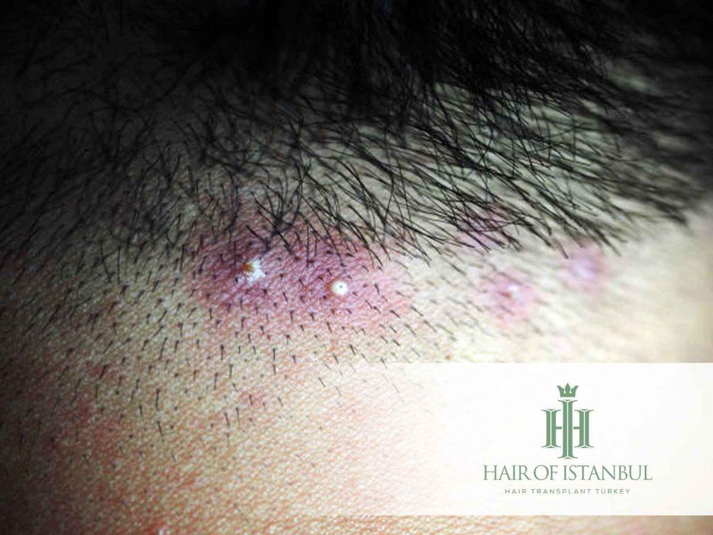 Ingrown Hairs After Hair Transplant: Telling the Bumps Apart