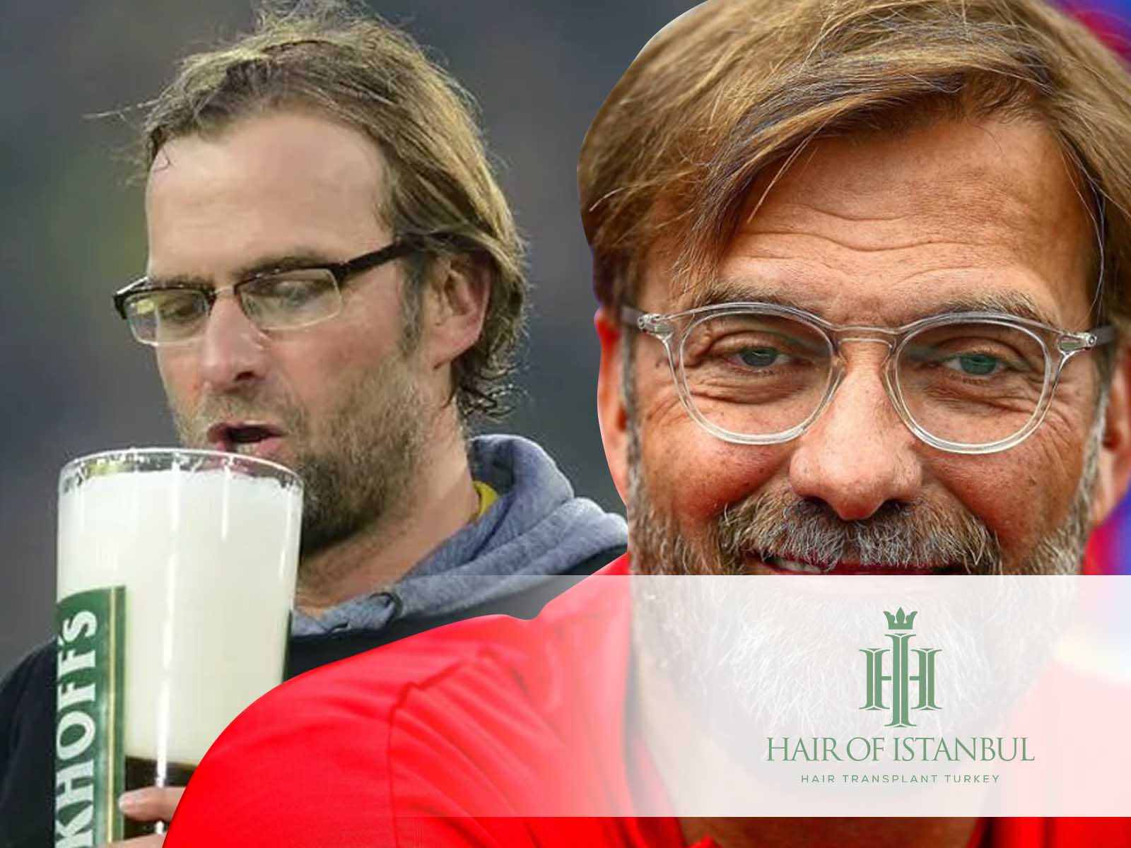 Jurgen Klopp Hair Transplant Secret Of His 1 Amazing Look