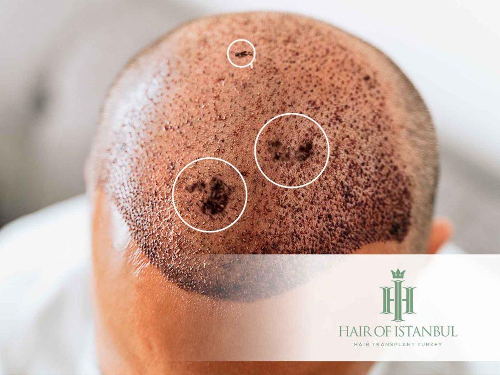 Scalp Necrosis After Hair Transplant: Causes, Signs and Prevention