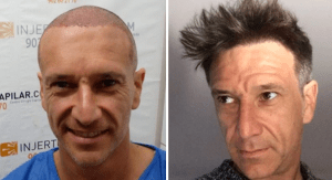 Alfonso Pérez Muñoz y su injerto de pelo