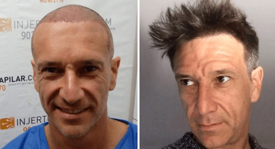 Injerto de Pelo de Alfonso Pérez Muñoz: Antes y Después y Resultados Reales 1 Alfonso Pérez Muñoz y su injerto de pelo