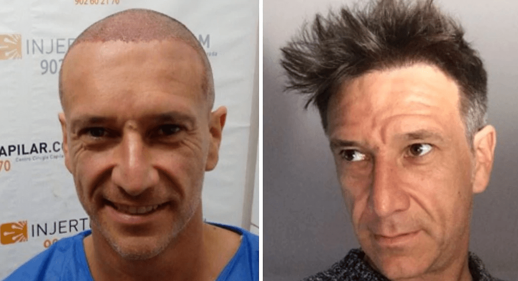 Alfonso Pérez Muñoz y su injerto de pelo: fotos antes y después