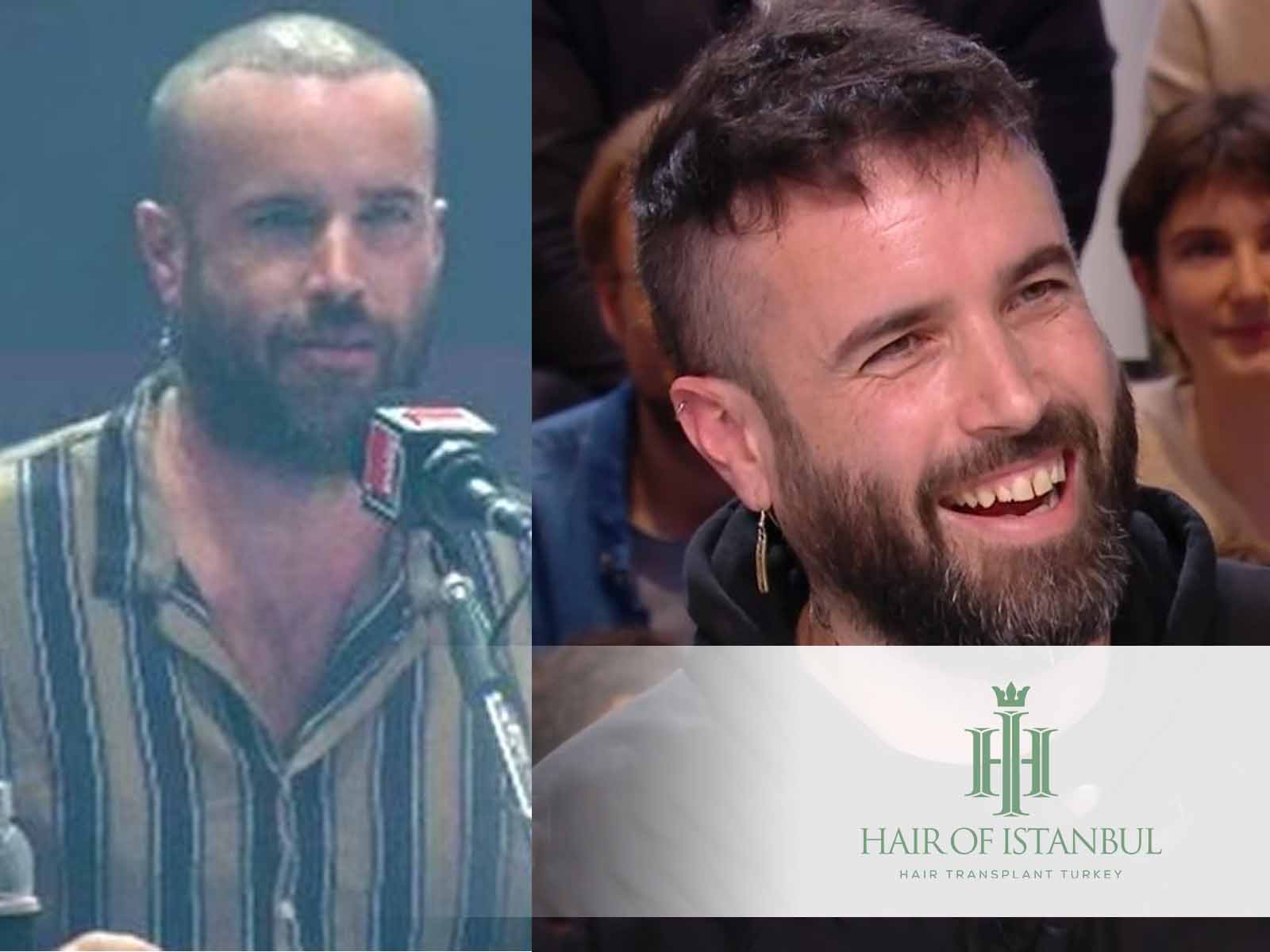 Greffe de cheveux à Aymeric Lompret : les détails révélés