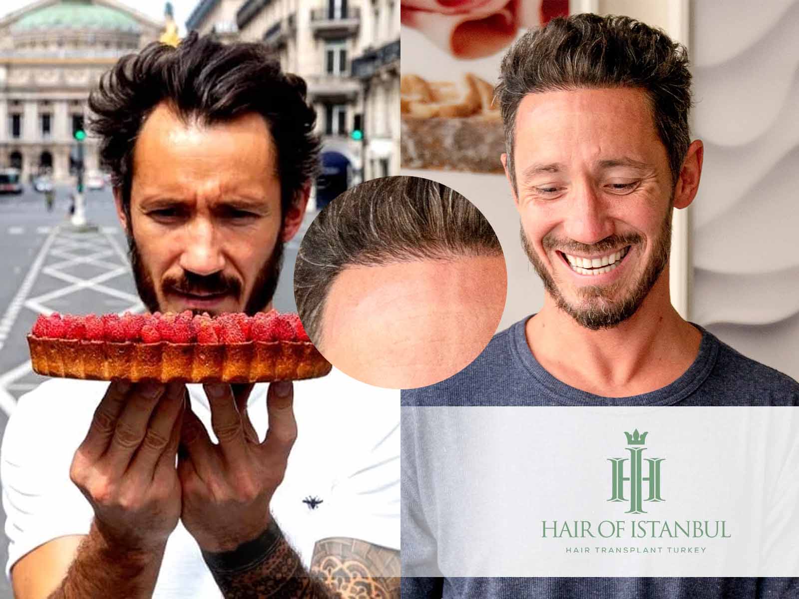 Greffe de cheveux à Cédric Grolet : décision et résultats