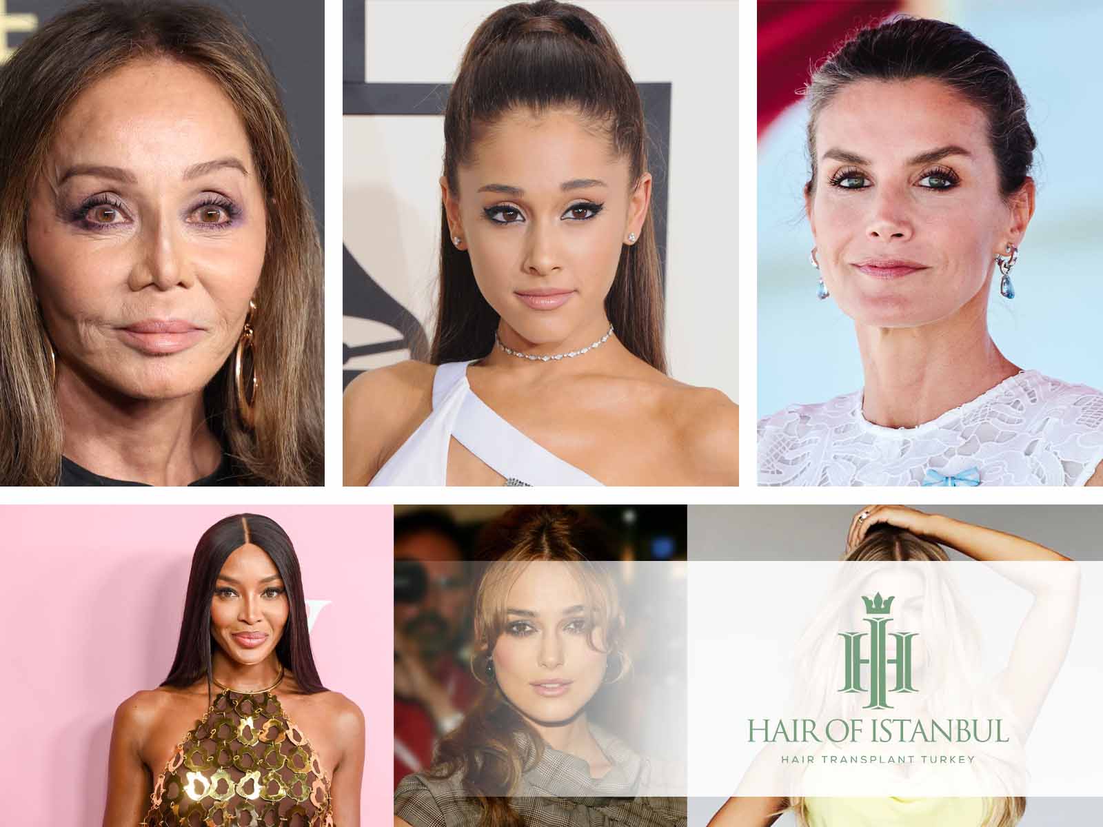 El injerto capilar en mujeres famosas: Historias de transformación