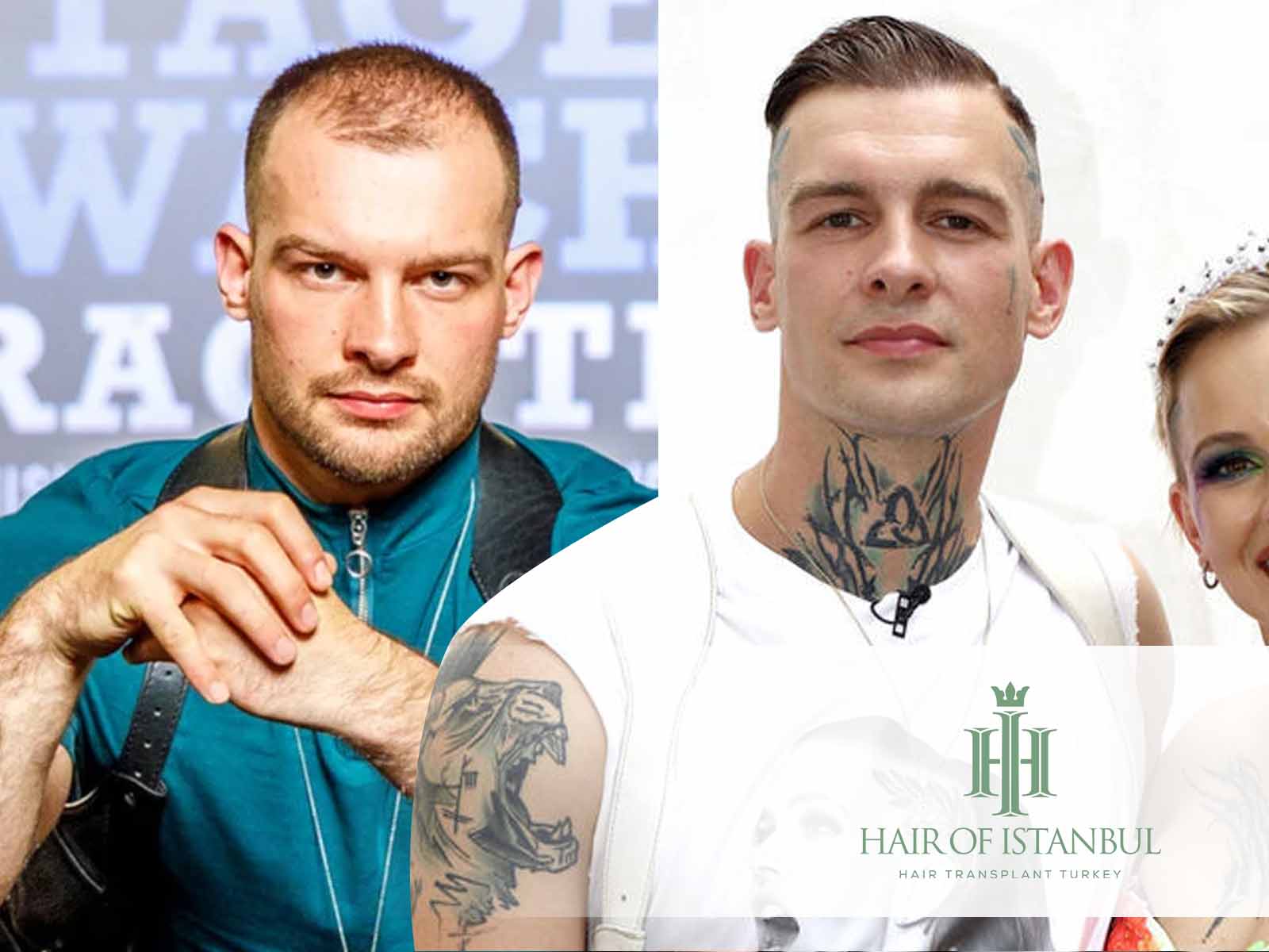 Eric Stehfest Haartransplantation: Haare zurückgewonnen