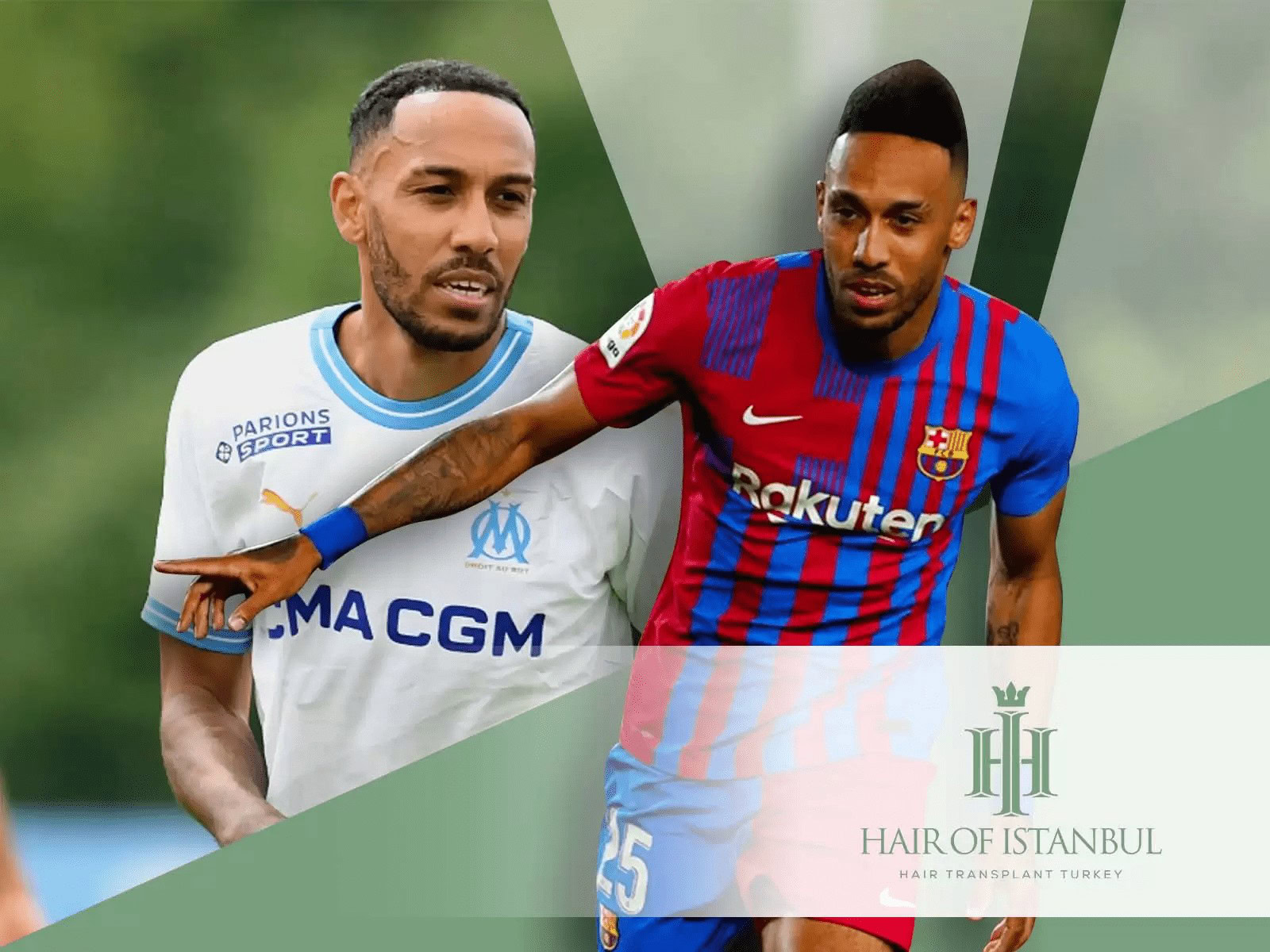Greffe de Capilar d'Aubameyang : Une Transformation Naturelle et Elégante 1 Greffe de cheveux à Aubameyang