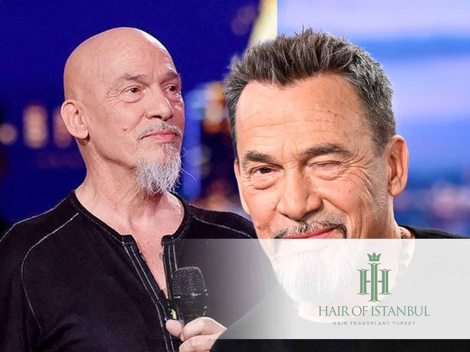 Greffe de cheveux à Florent Pagny : Nouveau Look Dévoilé