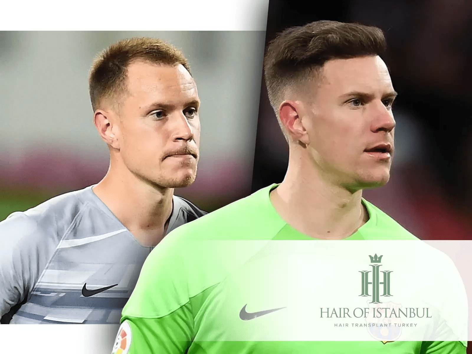 Greffe de cheveux à Ter Stegen : Décision et Conséquences