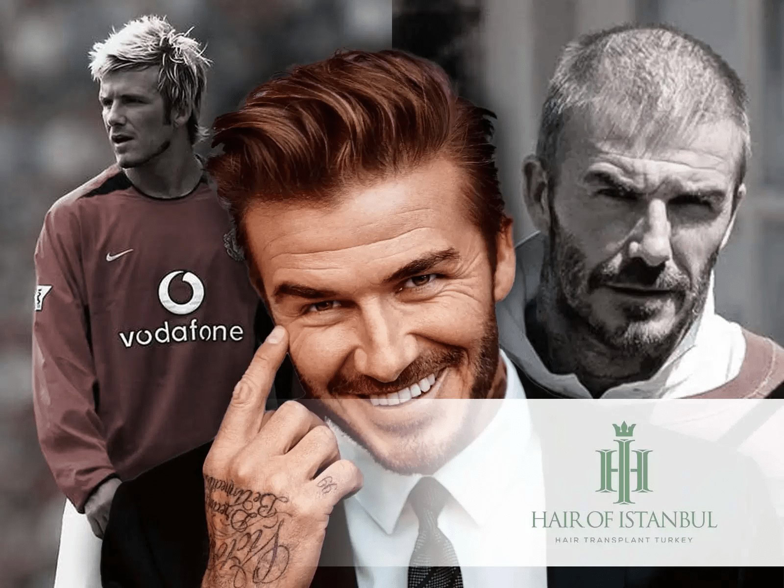 Greffe de cheveux de David Beckham: Influence sur l'Image 1 Greffe de cheveux de David Beckham