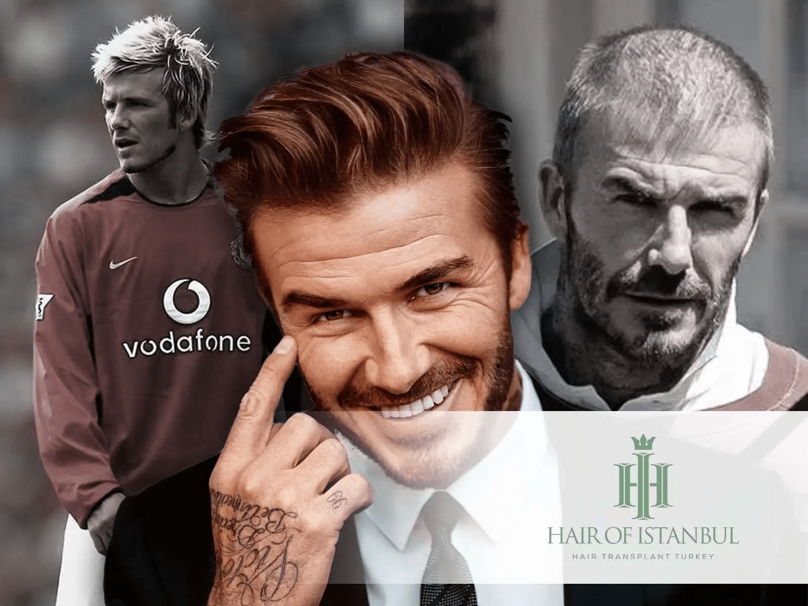 Greffe de cheveux de David Beckham: Influence sur l’Image