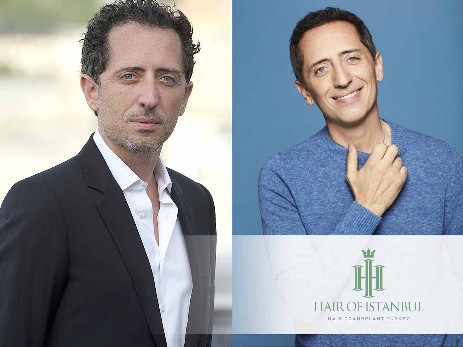 Greffe de cheveux de Gad Elmaleh: Transformation ou rumeur?