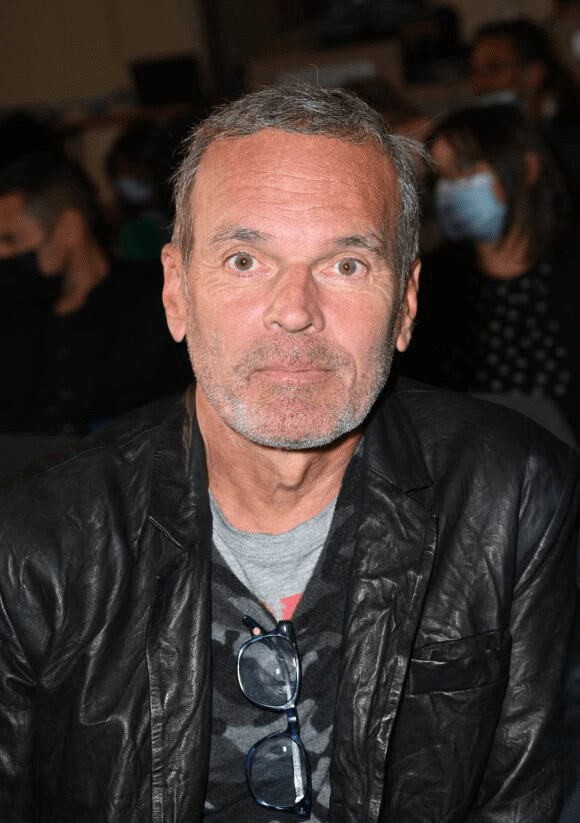 Greffe de cheveux de Laurent Baffie - après