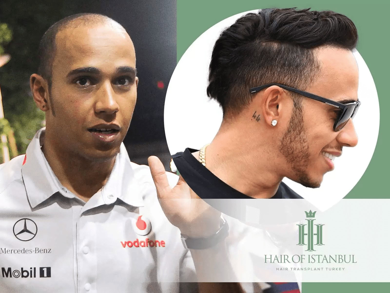 Greffe de cheveux de Lewis Hamilton