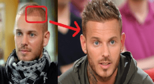 Greffe de cheveux de Matt Pokora