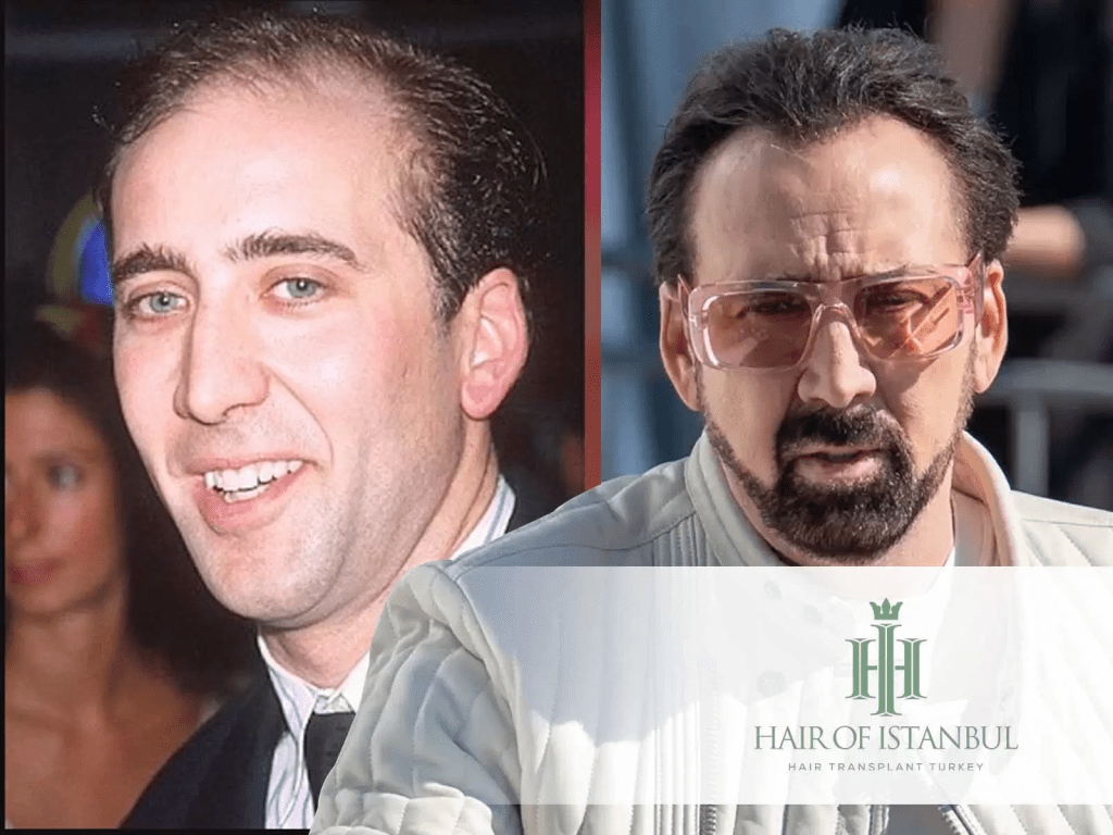 Greffe de cheveux de Nicolas Cage